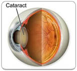 What is cataract
