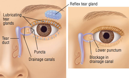 Tear Duct Infection (Dacryocystitis)