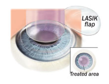 Picture of LASIK procedure