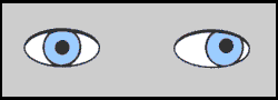Exotropia, often called "wall-eye" in the past