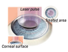 Picture of PRK procedure
