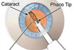 Painless Cataracts Surgery