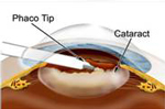 Phacoemulsification Cataract Surgery