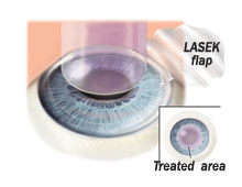 Picture of LASEK procedure