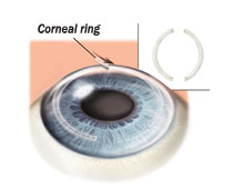 Picture of corneal rings