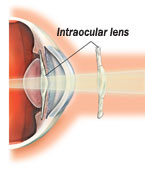 Picture of phakic intraocular lenses
