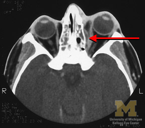Subperiosteal abscess